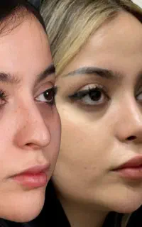 جراحی بینی/برای مراجعین شهر ایلام