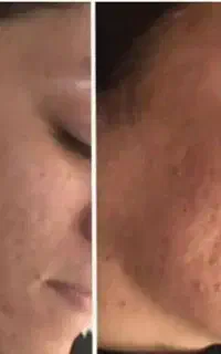 پک باور نکردنی درمان لک و جوش