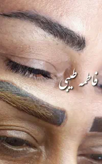 ریموو(پاک کردن تتو) با تضمین سلامت پوست