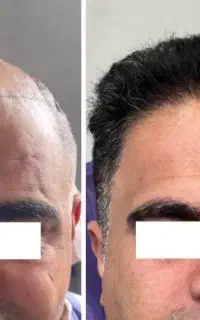 کاشت مو اقساطی