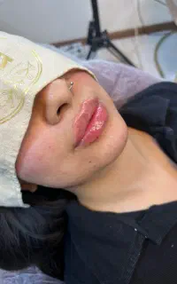 بوتاکس لیزر ریمو تتو ژل جوانساز لاغری فیشال لک