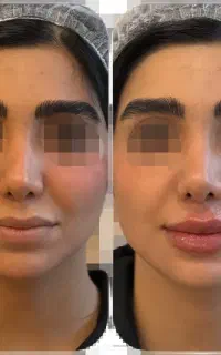 بوتاکس پیشانی و خط اخم - دکتر مریم هلاکو