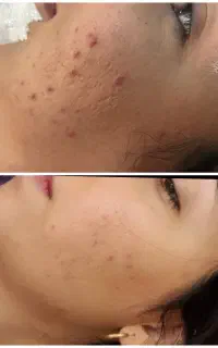 آموزش فیشال و پاکسازی صفرتاصد حرفه ای ونیازمند مدل