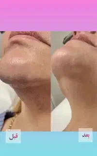 لیزر مو زائد بانوان شاتی بی درد الکساندرایت نابلکس