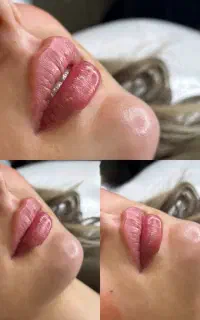 مرکز تخصصی فیلر و مزوژل جوانساز