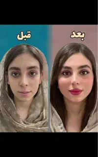 جشنواره تخفیف بوتاکس فیلر و مزو ژل و خال برداری