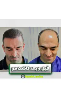 کاشت مو با اقساط ۴ماهه