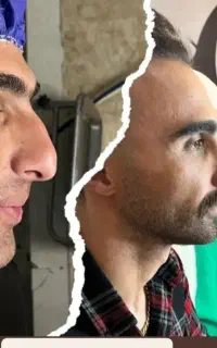 چشنواره تخفیف عمل بینی 45م