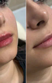 فیلرلب/با پزشک /فیلر لیبل دار /قیمت مناسب/طبیعی