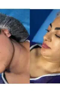 ساکشن