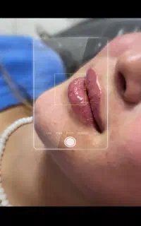 فیلر،بوتاکس،مزوتراپی،تمام خدمات زییایی