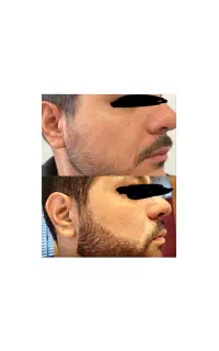 مردونه تر شو با ریش پرتر