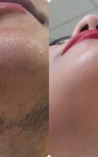 لیزر تخصصی ویژه آقایون