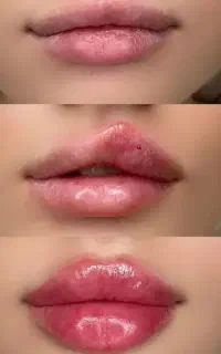 آف آموزش و تزریق فوق تخصصی فیلر بوتاکس(بمدت محدود)