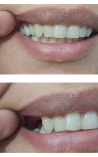 دندانسازی دندان مصنوعی تیکه‌ای هرفک 1تا8 دندان