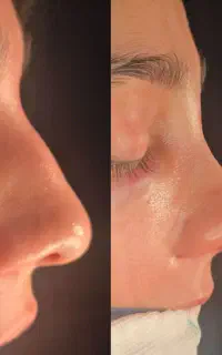 جراحی زیبایی بینی توسط متخصص گوش حلق بینی