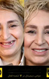 کاشت ایمپلنت فوری با بهترین متریال۱۴۷۰۰