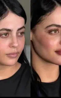 تزریق چربی صورت ،بیکینی ،سینه و دست