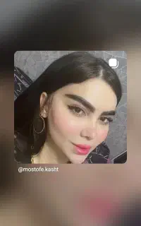 کاشت مو و ابرو