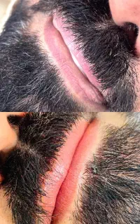 رفع کبودی لب