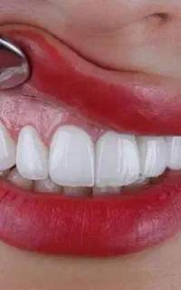 کامپوزیت از ۱م  ایمپلنت دندان ۲۰م روکش.عصب کشی