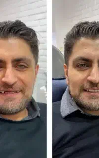 دندان مصنوعی دبل جوانان