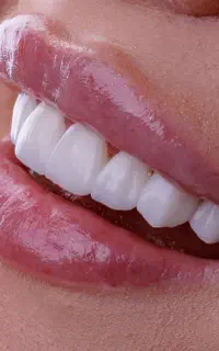 دندانپزشکی اقساطی، کامپوزیت، لمینت و عصب‌کشی