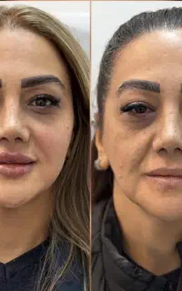 کانتورینگ (فیلر ) فول فیس صورت +بوتاکس رایگان