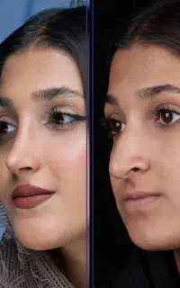 جراحی بینی با قیمت سال قبل+اقساط+مشاوره رایگان