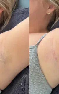 لیزر از چهل هزار تومان.