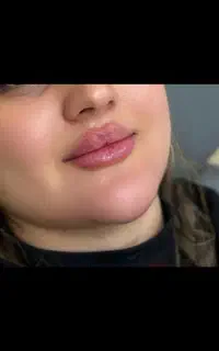 تزریق ژل و بوتاکس برازجان