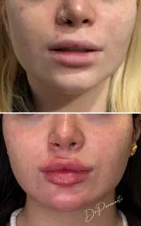 آموزش ژل و بوتاکس