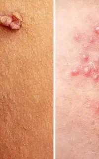 برای بهبودی کامل تبخال و زگیل اقدام کن