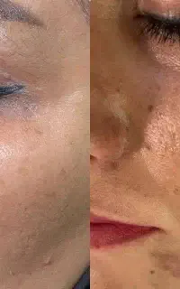 بهبود لک و جوانسازی