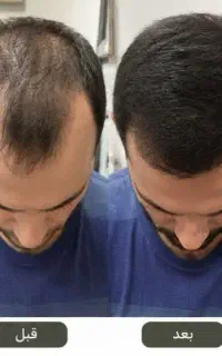 درمان ریزش مو و رویش مجدد