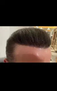 کاشت مو در کلینیک آفرینش شعبه اهر