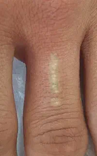 (کلینیک دنا)پاکسازی تاتو با دستگاه پیکوسکند امریکا