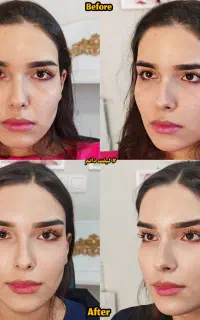 جراحی های زیبایی لیفت شقیقه ابرو صورت غبغب پلک