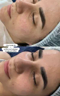 تخفیف خدمات پاکسازی فیشیال درمانی ۳ روزه