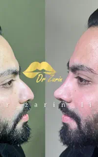ژل لب روسی متدMمادلینگ خط لبخندفیلربینی گونه شقیقه