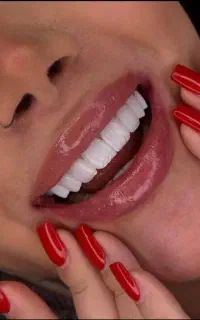 ایمپلنت کامپوزیت لمینت دارای شرایط اقساطی استثنایی