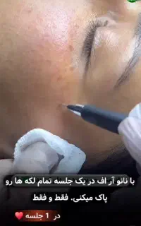 حذف لک فقط و فقط در یک جلسه