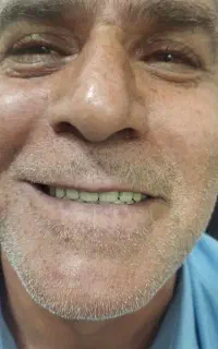 دندان سازی دندان مصنوعی متحرک و ثابت با ضمانت د