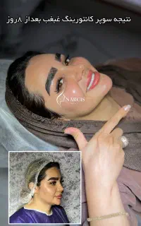 جشنواره ساکشن غبغب/بوکال فت/زاویه سازی دائم