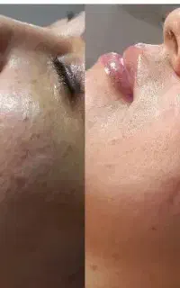 فیشیال تخصصی پوست جلسه اول هدیه ویژه