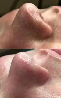 فیشیال/ پاکسازی تخصصی/مزونیدلینگ