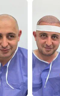 کاشت مو ابرو و ریش