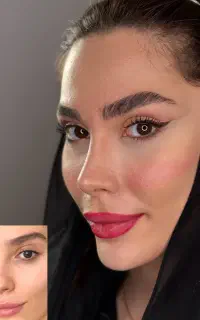 جراحی بینی کلینیک مهرزاد- اقساط و ۱۰ میلیون تخفیف