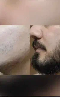 رویش ریش و سبیل تضمیمی
