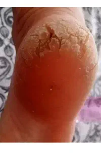 منگوله گوشتی وچین وچروک